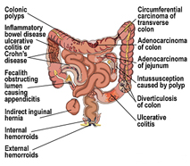diseased intestine ard.jpg